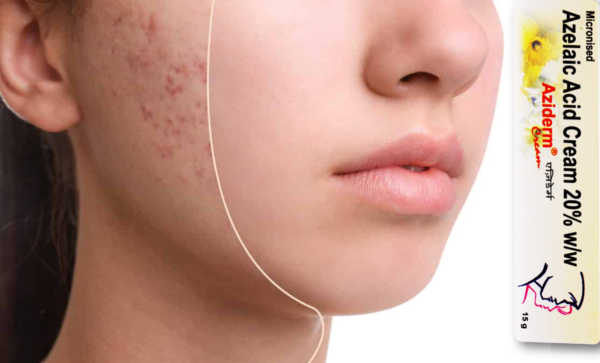 Aziderm Cream 3