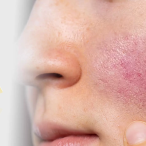 Aziderm Cream 4