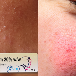 Aziderm Cream 7