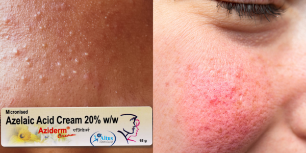 Aziderm Cream 7
