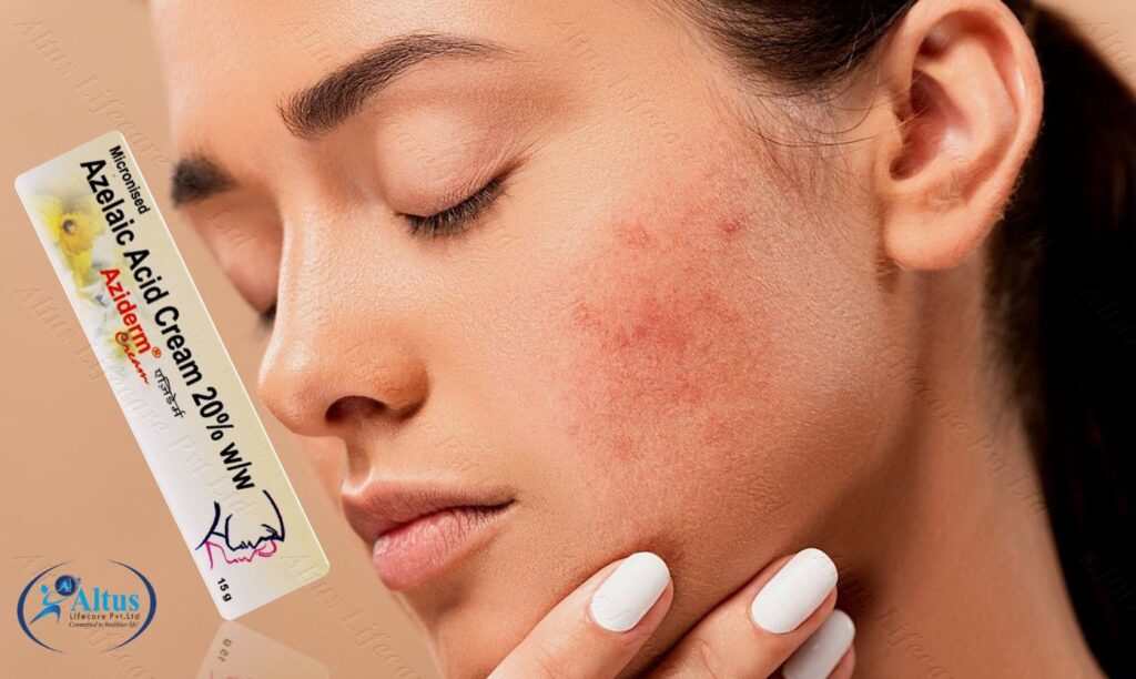 Aziderm Cream 1